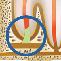 치근단절제술 STEP4 - MTA 충전 마무리