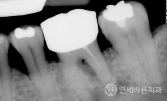 재신경치료 케이스1 사진
