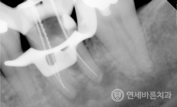 재신경치료 케이스1 사진