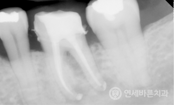 재신경치료 케이스1 사진