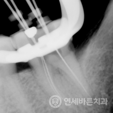재신경치료 케이스2 사진