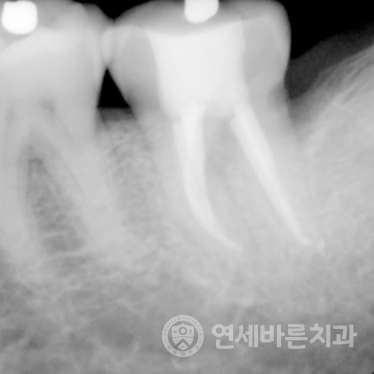 재신경치료 케이스2 사진